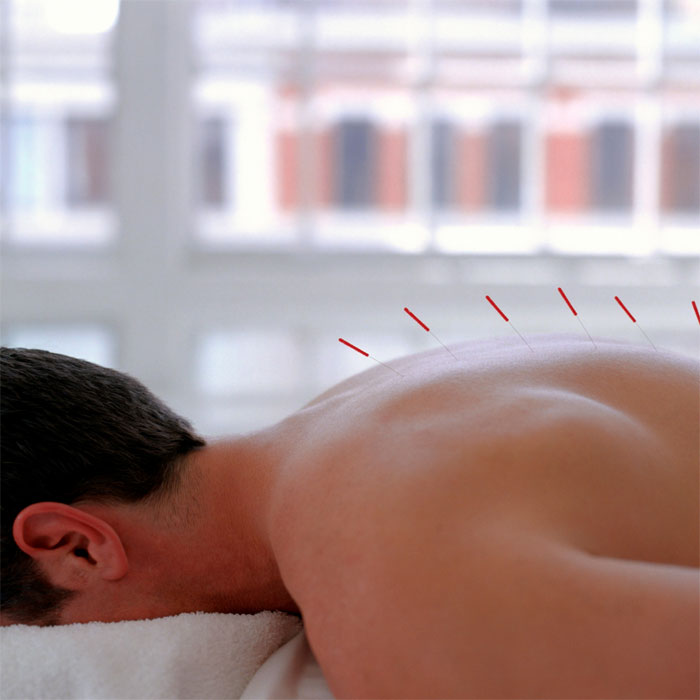 Acupuncture image